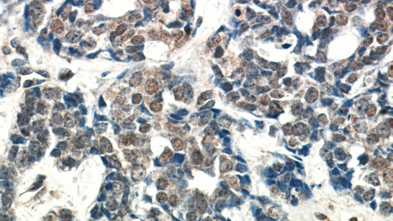 Immunohistochemical of paraffin-embedded human cervical cancer using Catalog No:107948(AKT antibody) at dilution of 1:50 (under 40x lens)