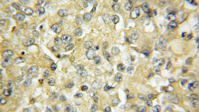 Immunohistochemical of paraffin-embedded human lung cancer using Catalog No:115156(SFTPA1 antibody) at dilution of 1:50 (under 10x lens)