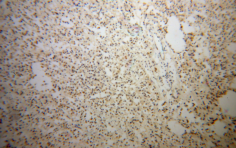 Immunohistochemical of paraffin-embedded human breast cancer using Catalog No:115907(TCF7L1 antibody) at dilution of 1:100 (under 10x lens)