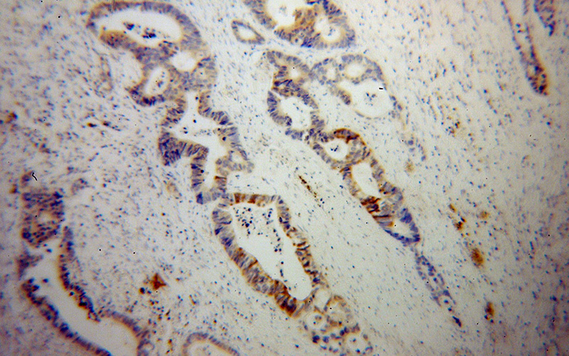 Immunohistochemical of paraffin-embedded human colon cancer using Catalog No:115011(SCNN1G antibody) at dilution of 1:100 (under 10x lens)