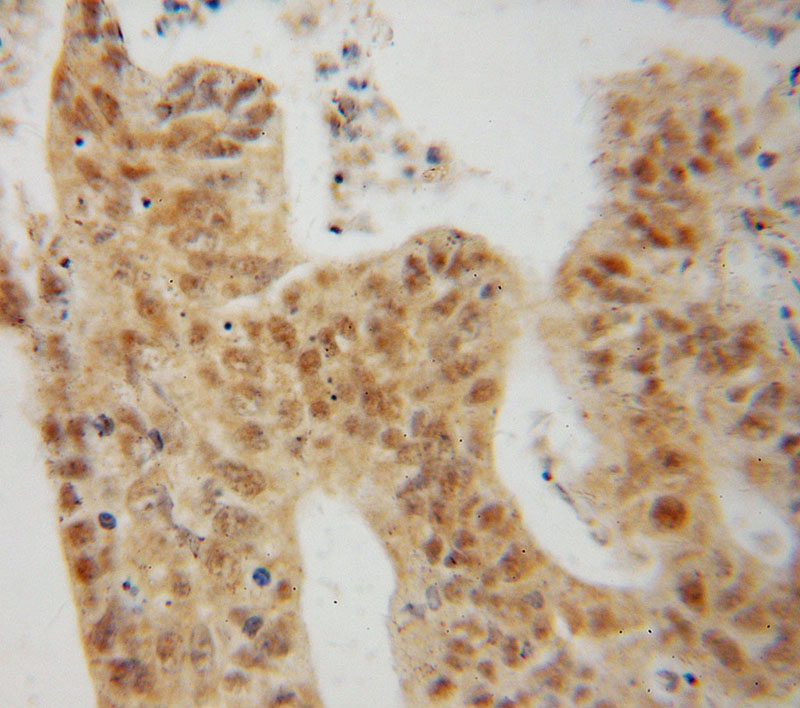 Immunohistochemical of paraffin-embedded human colon cancer using Catalog No:112473(MAP1S antibody) at dilution of 1:50 (under 40x lens)