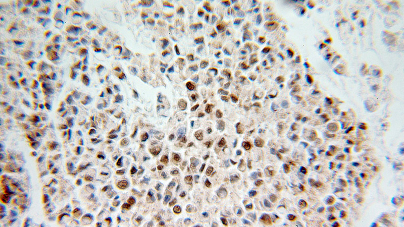 Immunohistochemical of paraffin-embedded human colon cancer using Catalog No:108380(BCAS2 antibody) at dilution of 1:100 (under 25x lens)