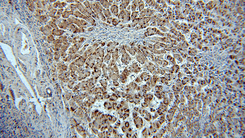 Immunohistochemical of paraffin-embedded human hepatocirrhosis using Catalog No:108884(CAT antibody) at dilution of 1:100 (under 10x lens)