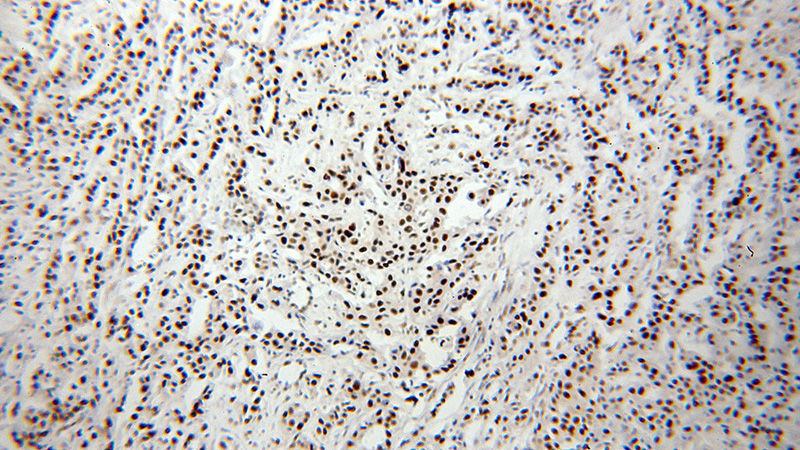 Immunohistochemical of paraffin-embedded human breast cancer using Catalog No:115133(SF3A1 antibody) at dilution of 1:400 (under 10x lens)