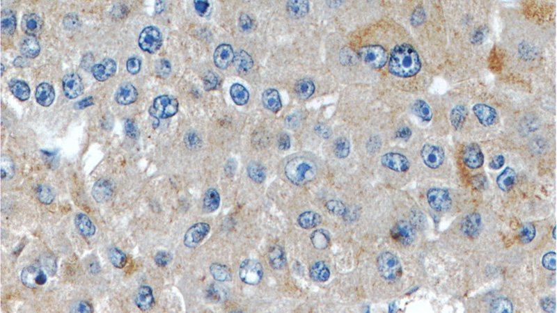Immunohistochemistry of paraffin-embedded human liver cancer tissue slide using Catalog No:111697(IGHMBP2 Antibody) at dilution of 1:50 (under 40x lens)