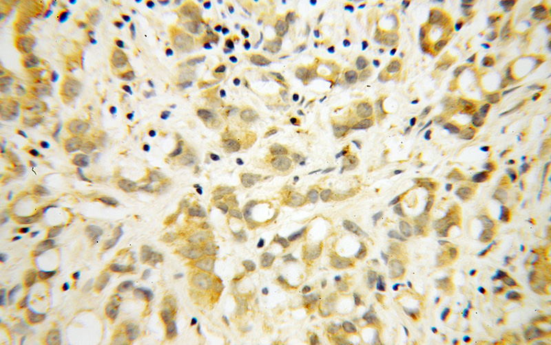 Immunohistochemical of paraffin-embedded human prostate cancer using Catalog No:114874(RPL18A antibody) at dilution of 1:100 (under 40x lens)
