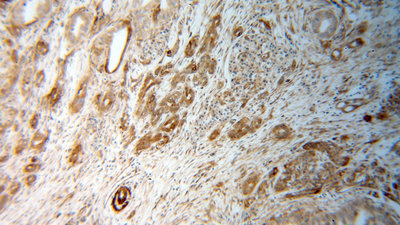 Immunohistochemical of paraffin-embedded human pancreas cancer using Catalog No:114841(RPS28 antibody) at dilution of 1:50 (under 10x lens)