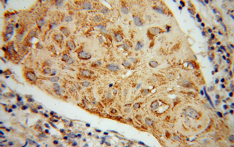 Immunohistochemical of paraffin-embedded human cervical cancer using Catalog No:107807(ABCG1 antibody) at dilution of 1:100 (under 40x lens)