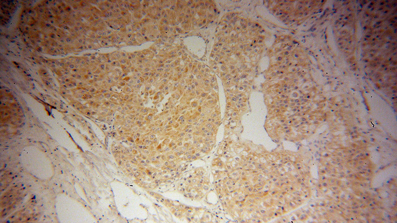 Immunohistochemical of paraffin-embedded human liver cancer using Catalog No:109696(CYP2J2 antibody) at dilution of 1:50 (under 10x lens)