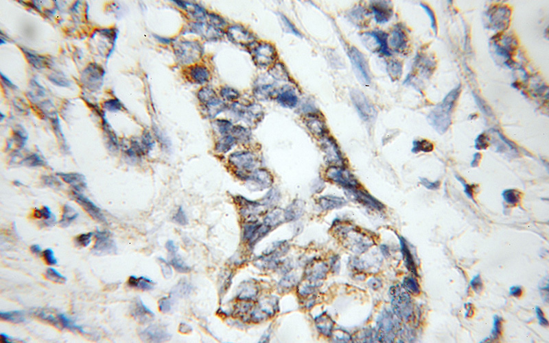 Immunohistochemical of paraffin-embedded human pancreas cancer using Catalog No:108188(ARHGEF5 antibody) at dilution of 1:50 (under 10x lens)