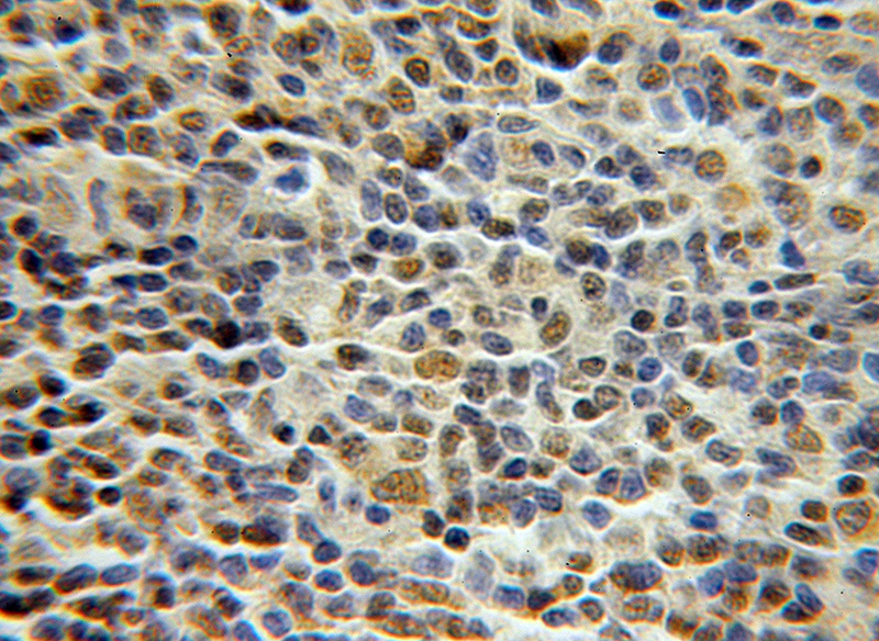 Immunohistochemical of paraffin-embedded human lymphoma using Catalog No:113745(PCNP antibody) at dilution of 1:50 (under 10x lens)