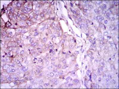 Immunohistochemical analysis of paraffin-embedded lung cancer tissues using RAB4A mouse mAb with DAB staining.