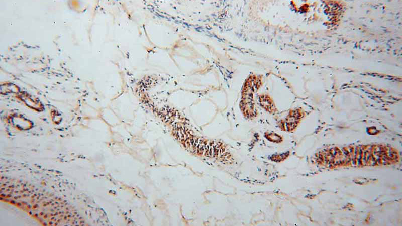 Immunohistochemical of paraffin-embedded human skin cancer using Catalog No:110411(EXOSC4 antibody) at dilution of 1:100 (under 10x lens)