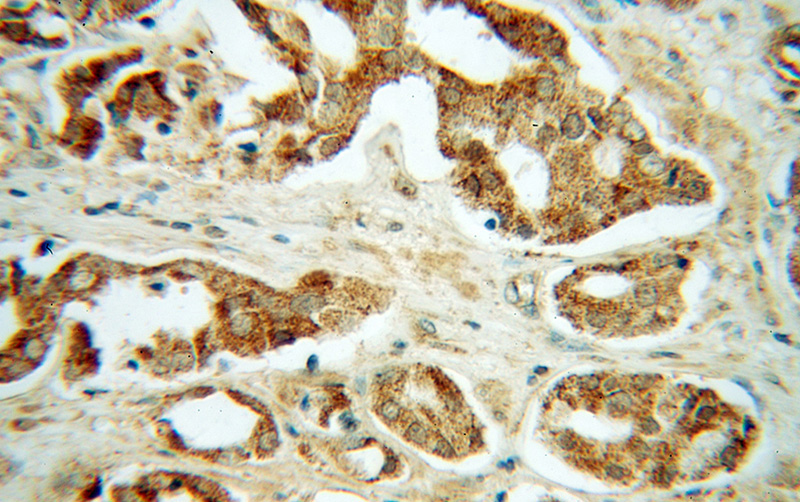 Immunohistochemical of paraffin-embedded human prostate cancer using Catalog No:111013(GNS antibody) at dilution of 1:100 (under 40x lens)