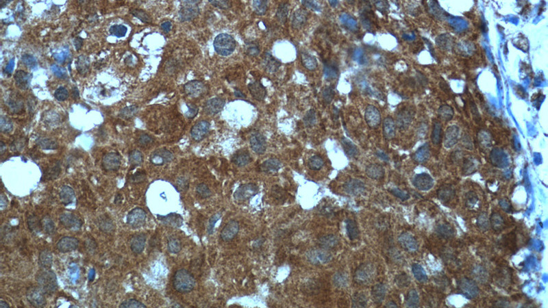Immunohistochemistry of paraffin-embedded human breast cancer tissue slide using Catalog No:108073(ANKRD27 Antibody) at dilution of 1:50 (under 40x lens)