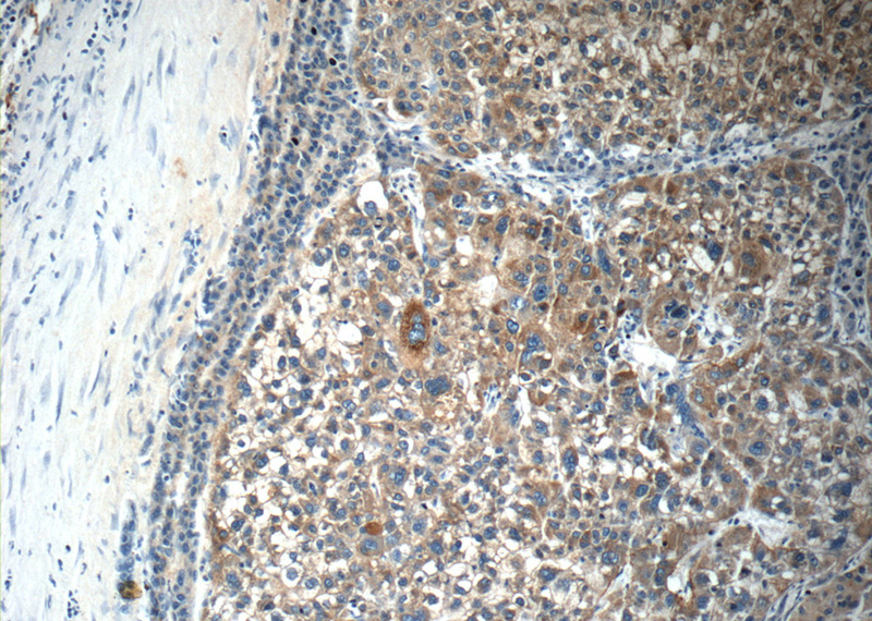 Immunohistochemistry of paraffin-embedded human liver cancer tissue slide using Catalog No:108728(C4BPA Antibody) at dilution of 1:50 (under 10x lens)