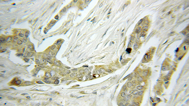 Immunohistochemical of paraffin-embedded human breast cancer using Catalog No:112849(MRPS22 antibody) at dilution of 1:50 (under 10x lens)