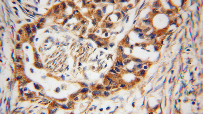 Immunohistochemical of paraffin-embedded human endometrial cancer using Catalog No:107761(ADAM12 antibody) at dilution of 1:100 (under 40x lens)