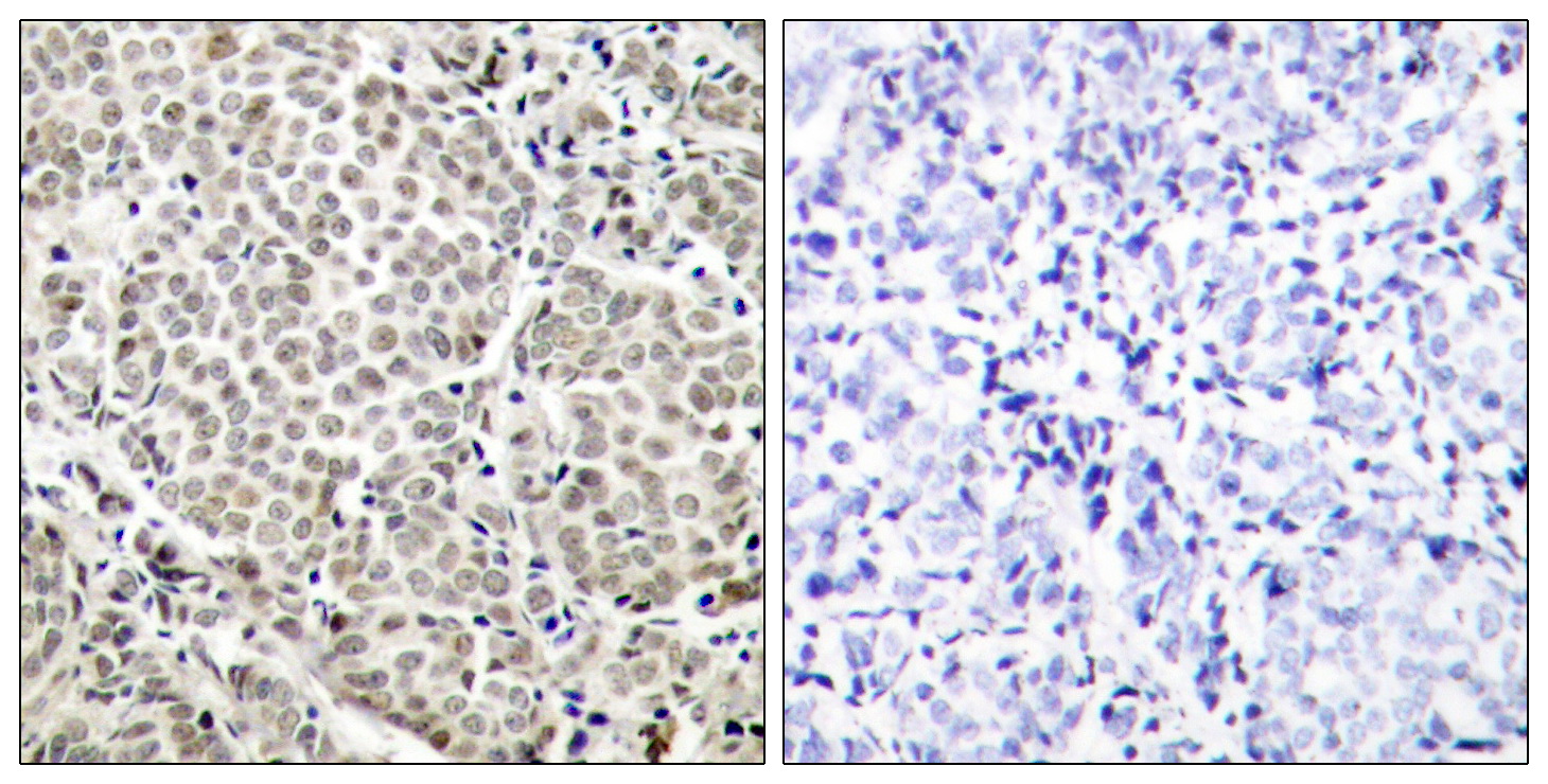 Immunohistochemical analysis of paraffin-embedded human breast carcinoma tissue using NFu03baB-p65 (Phospho-Ser529) Antibody  (left) or the same antibody preincubated with blocking peptide (right).
