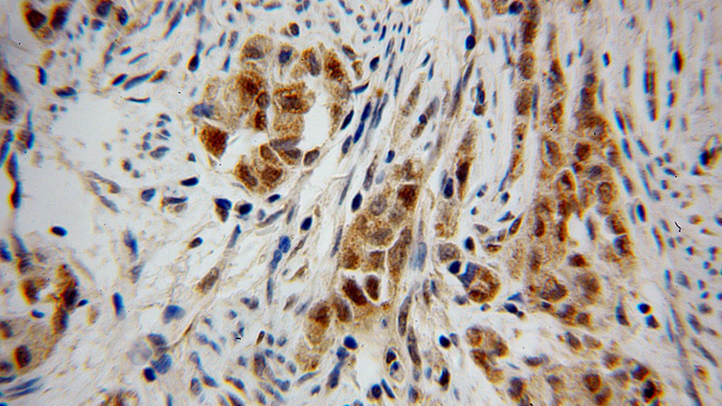 Immunohistochemical of paraffin-embedded human endometrial cancer using Catalog No:109224(CHFR antibody) at dilution of 1:100 (under 40x lens)