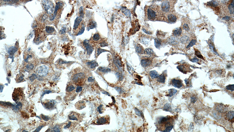 Immunohistochemical of paraffin-embedded human breast cancer using Catalog No:116852(WDFY3 antibody) at dilution of 1:50 (under 40x lens)