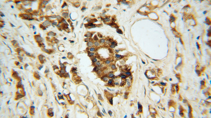 Immunohistochemical of paraffin-embedded human prostate cancer using Catalog No:108256(ARG2 antibody) at dilution of 1:100 (under 40x lens)