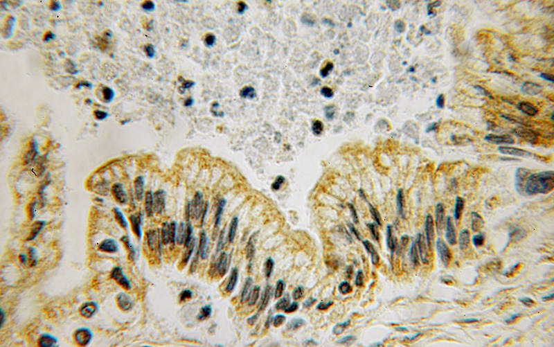 Immunohistochemical of paraffin-embedded human pancreas cancer using Catalog No:111752(ILK antibody) at dilution of 1:100 (under 10x lens)