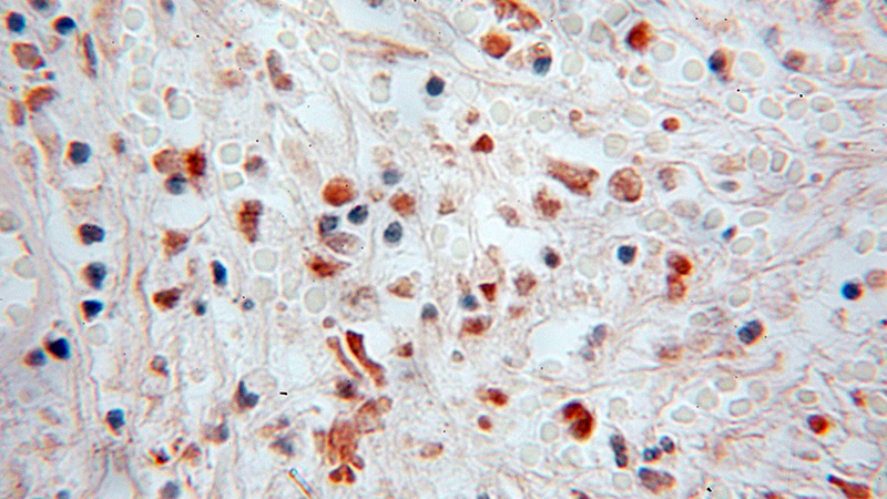 Immunohistochemical of paraffin-embedded human colon cancer using Catalog No:113144(NFE2 antibody) at dilution of 1:50 (under 10x lens)