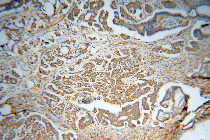Immunohistochemical of paraffin-embedded human ovary tumor using Catalog No:114496(RABEPK antibody) at dilution of 1:50 (under 10x lens)