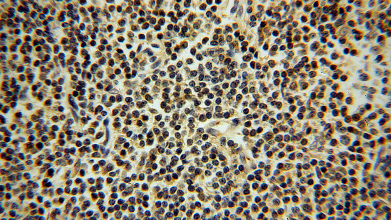 Immunohistochemical of paraffin-embedded human lymphoma using Catalog No:111212(ADRBK1 antibody) at dilution of 1:100 (under 40x lens)
