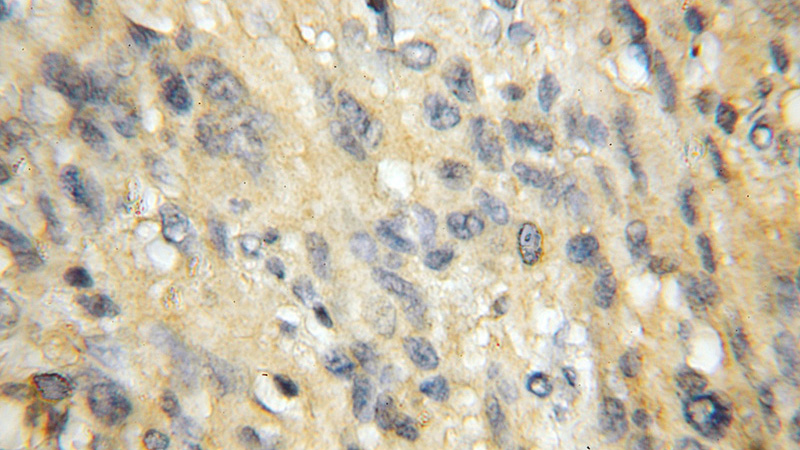 Immunohistochemical of paraffin-embedded human gliomas using Catalog No:110501(EXoc1 antibody) at dilution of 1:50 (under 10x lens)