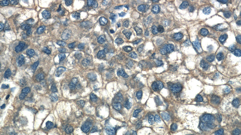 Immunohistochemistry of paraffin-embedded human liver cancer tissue slide using Catalog No:108933(CAP2 Antibody) at dilution of 1:50 (under 40x lens)
