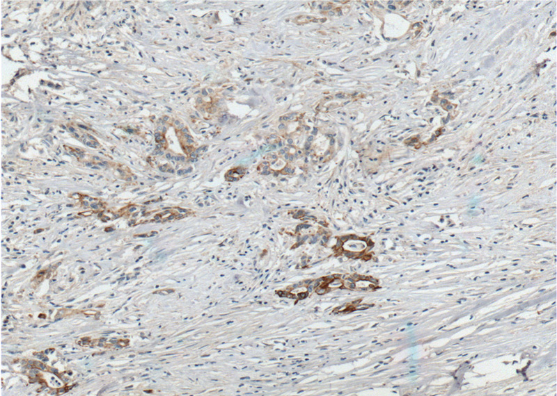 Immunohistochemistry of paraffin-embedded human pancreas cancer tissue slide using Catalog No:111087(GPC1 Antibody) at dilution of 1:200 (under 10x lens). heat mediated antigen retrieved with Tris-EDTA buffer(pH9).