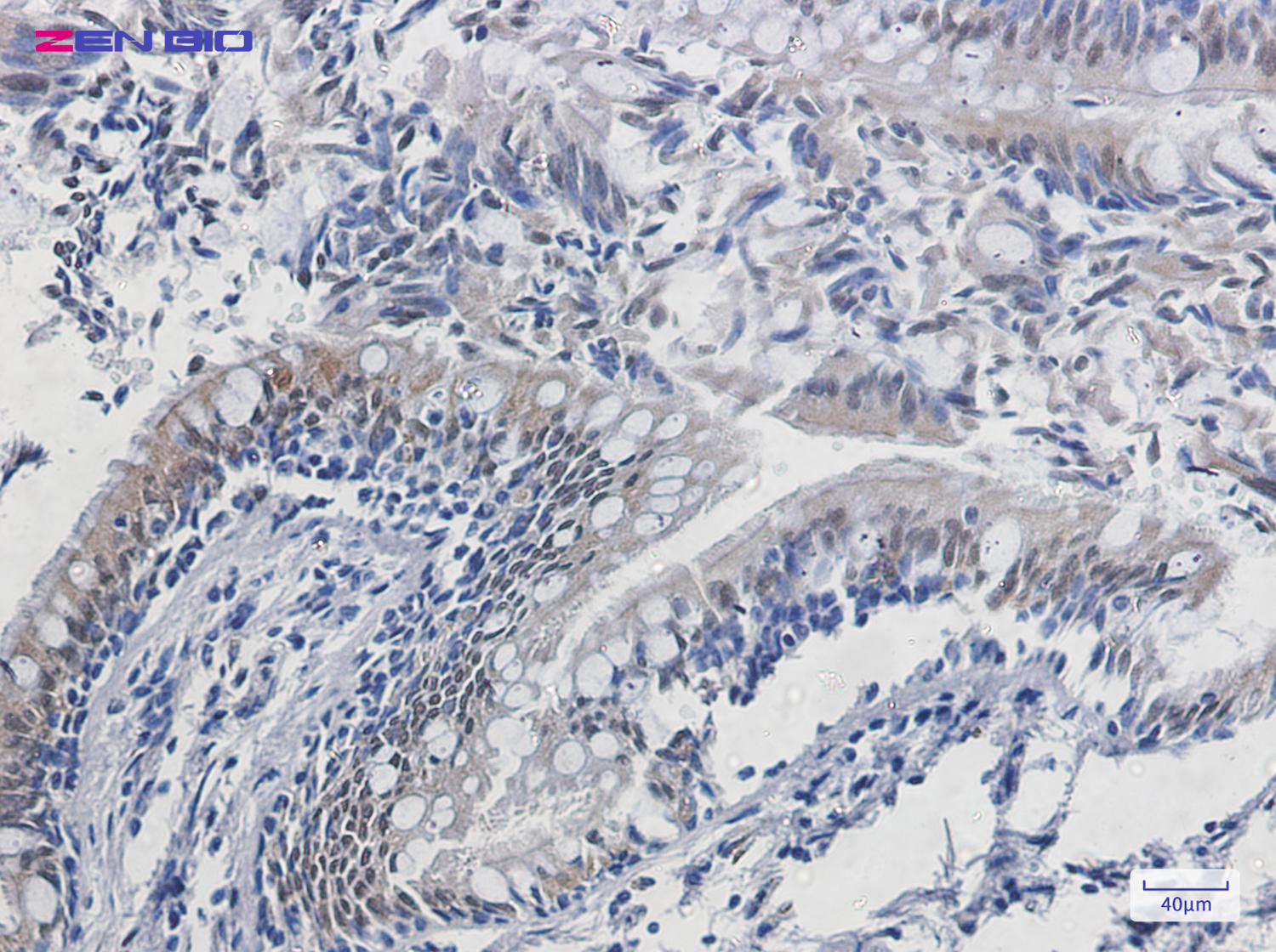 Immunohistochemistry of Tubulin Polymerization Promoting Protein in paraffin-embedded Human lung cancer tissue using Tubulin Polymerization Promoting Protein Rabbit pAb at dilution 1/20