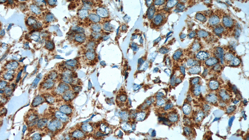 Immunohistochemistry of paraffin-embedded human breast cancer tissue slide using (Cytochrome c Antibody) at dilution of 1:600 (under 40x lens). heat mediated antigen retrieved with Tris-EDTA buffer(pH9).