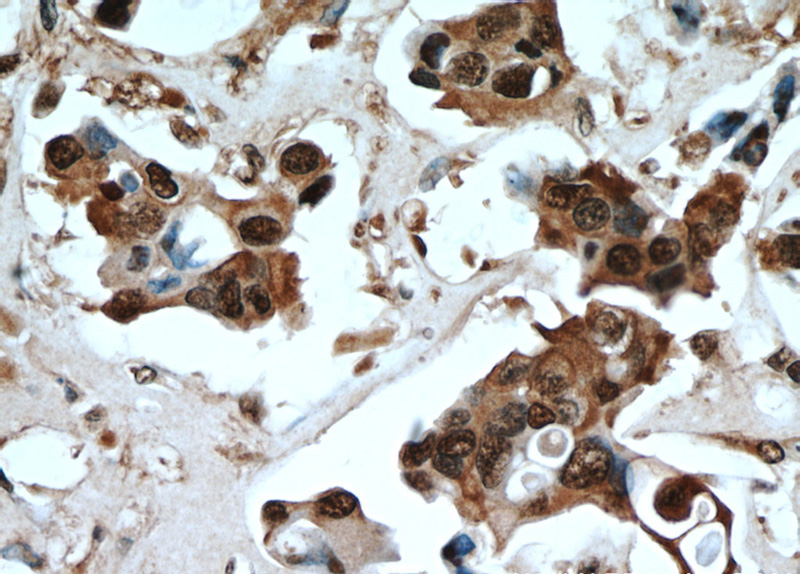 Immunohistochemical of paraffin-embedded human breast cancer using Catalog No:114385(PSMB5 antibody) at dilution of 1:50 (under 40x lens)