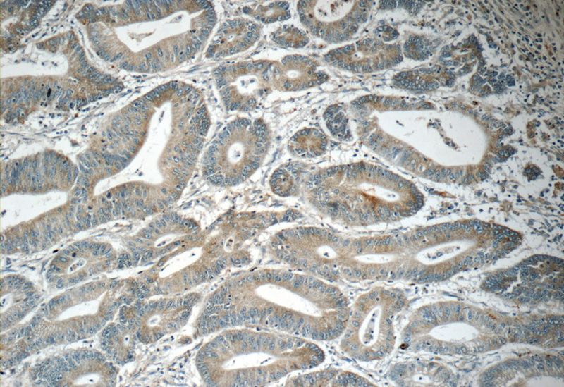 Immunohistochemistry of paraffin-embedded human colon cancer tissue slide using Catalog No:108194(NUAK1 Antibody) at dilution of 1:50 (under 10x lens)