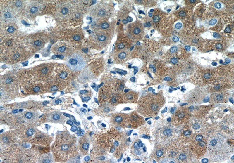 Immunohistochemistry of paraffin-embedded human hepatocirrhosis tissue slide using Catalog No:113571(PANK3 Antibody) at dilution of 1:50 (under 40x lens)