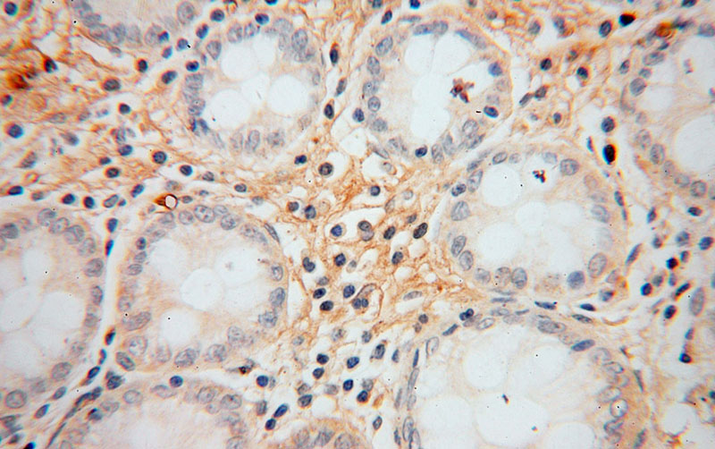 Immunohistochemical of paraffin-embedded human colon cancer using Catalog No:111085(GYPA antibody) at dilution of 1:50 (under 40x lens)