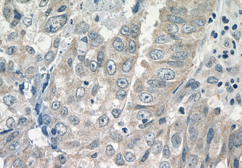 Immunohistochemistry of paraffin-embedded human breast cancer tissue slide using Catalog No:109506(CPEB1 Antibody) at dilution of 1:50 (under 40x lens)
