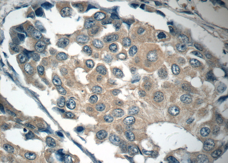 Immunohistochemistry of paraffin-embedded human breast cancer tissue slide using Catalog No:107180(c-SRC Antibody) at dilution of 1:50 (under 40x lens)
