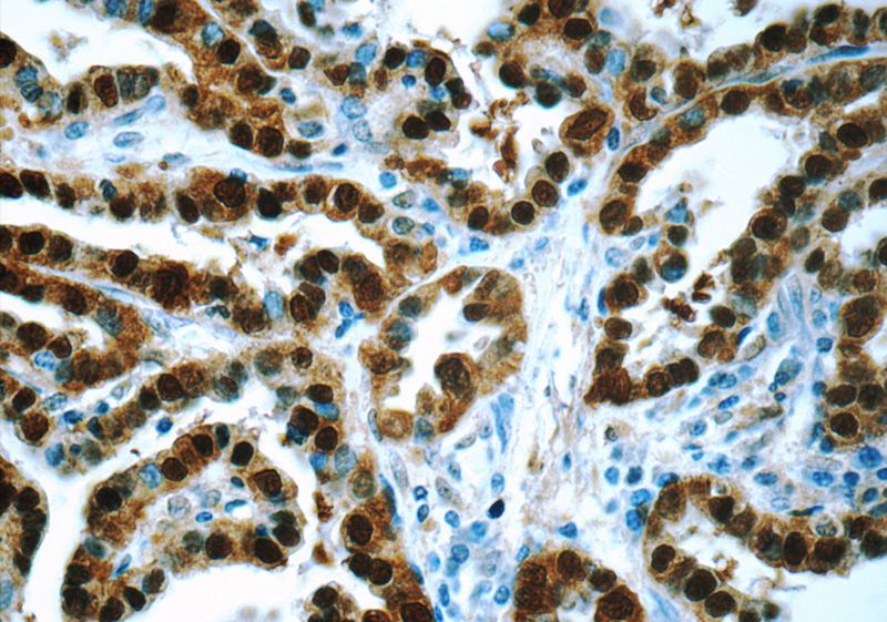 Immunohistochemistry of paraffin-embedded human thyroid cancer tissue slide using Catalog No:114957(S100A13 Antibody) at dilution of 1:50 (under 40x lens)