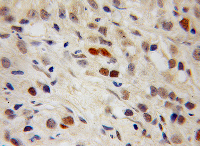 Immunohistochemical of paraffin-embedded human prostate cancer using Catalog No:114125(PPIG antibody) at dilution of 1:100 (under 10x lens)