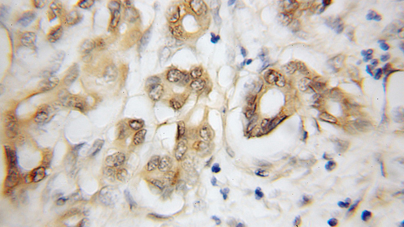 Immunohistochemical of paraffin-embedded human pancreas cancer using Catalog No:113125(NEUROD1 antibody) at dilution of 1:50 (under 10x lens)