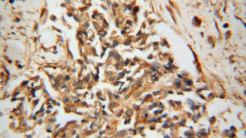 Immunohistochemical of paraffin-embedded human breast cancer using Catalog No:110579(FAM175A antibody) at dilution of 1:100 (under 40x lens)