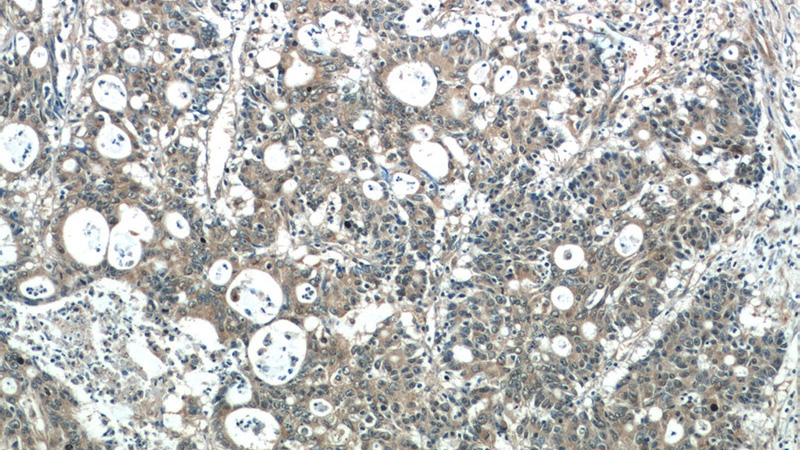 Immunohistochemistry of paraffin-embedded human colon cancer tissue slide using Catalog No:114992(SCFD2 Antibody) at dilution of 1:50 (under 10x lens)