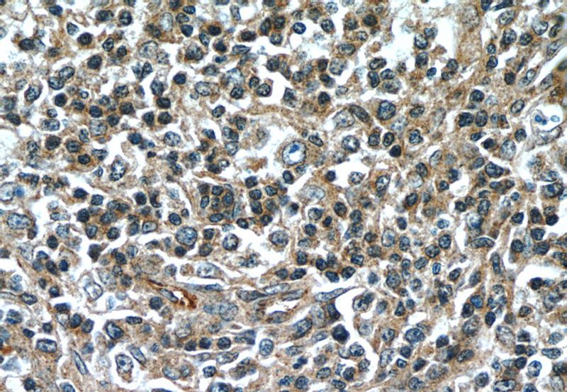 Immunohistochemistry of paraffin-embedded human lymphoma tissue slide using (CLEC11A Antibody) at dilution of 1:50 (under 40x lens)