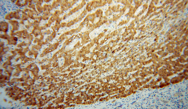 Immunohistochemical of paraffin-embedded human liver cancer using Catalog No:112535(MGAT1 antibody) at dilution of 1:100 (under 10x lens)