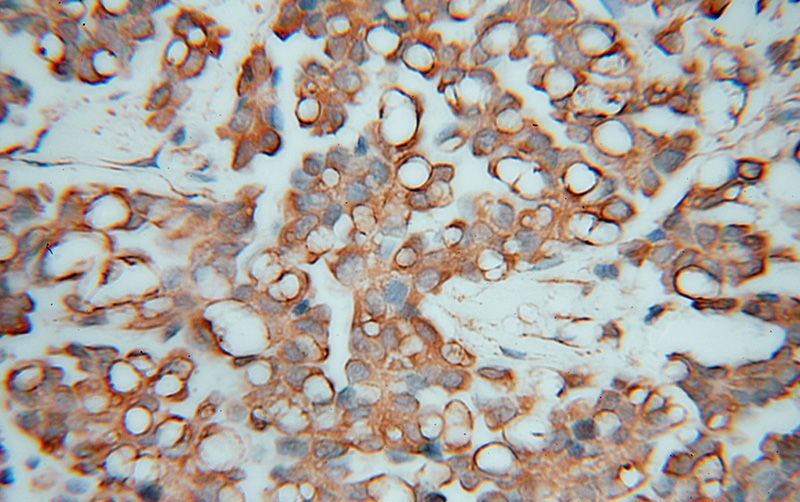 Immunohistochemical of paraffin-embedded human ovary tumor using Catalog No:114496(RABEPK antibody) at dilution of 1:50 (under 40x lens)