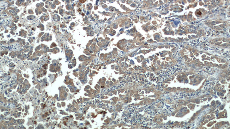 Immunohistochemical of paraffin-embedded human lung cancer using Catalog No:113871(PIK3CA antibody) at dilution of 1:50 (under 10x lens)